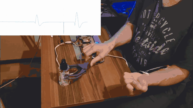 Prosthetic hand cycling through grip patterns under single-EMG control